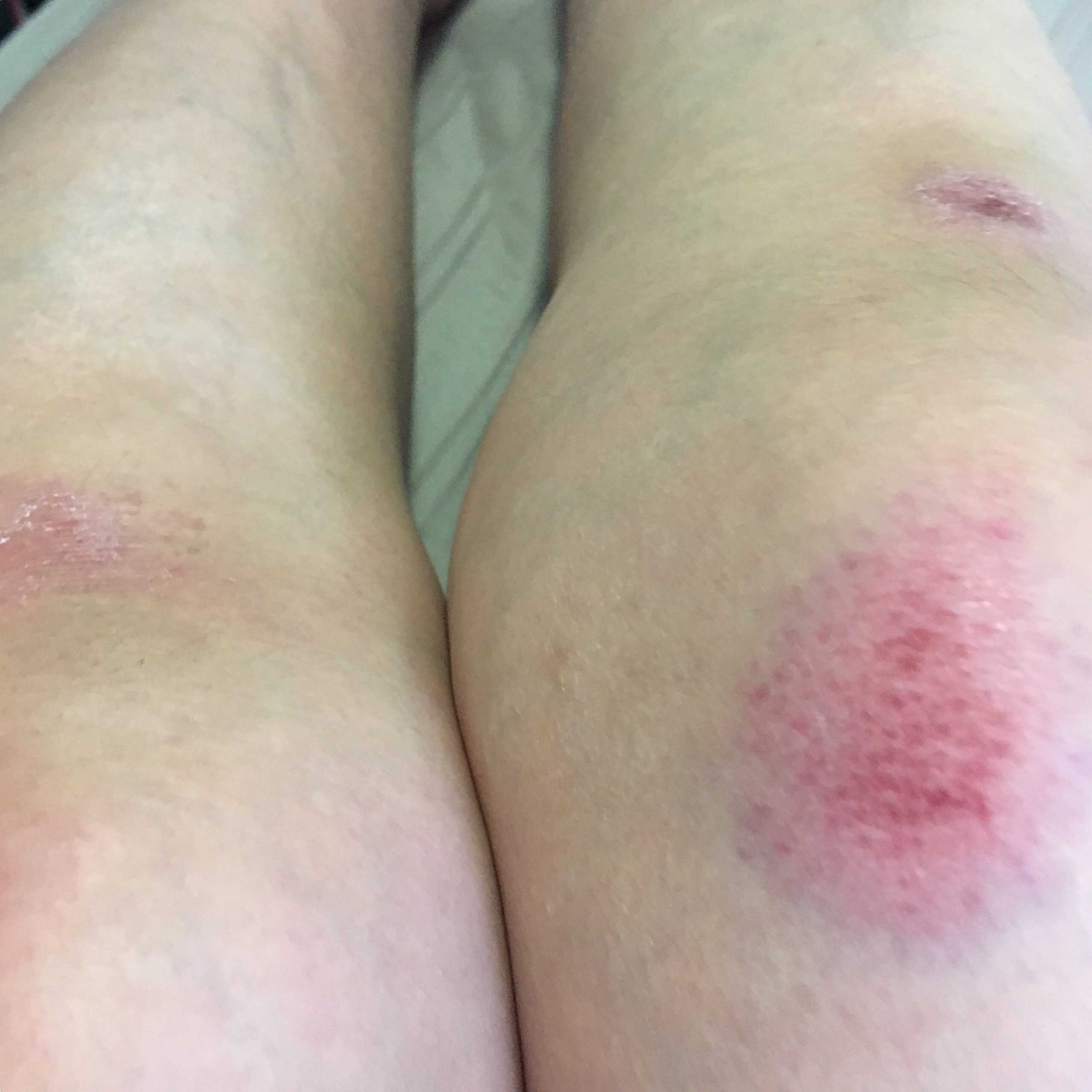 Close up image of bruised legs