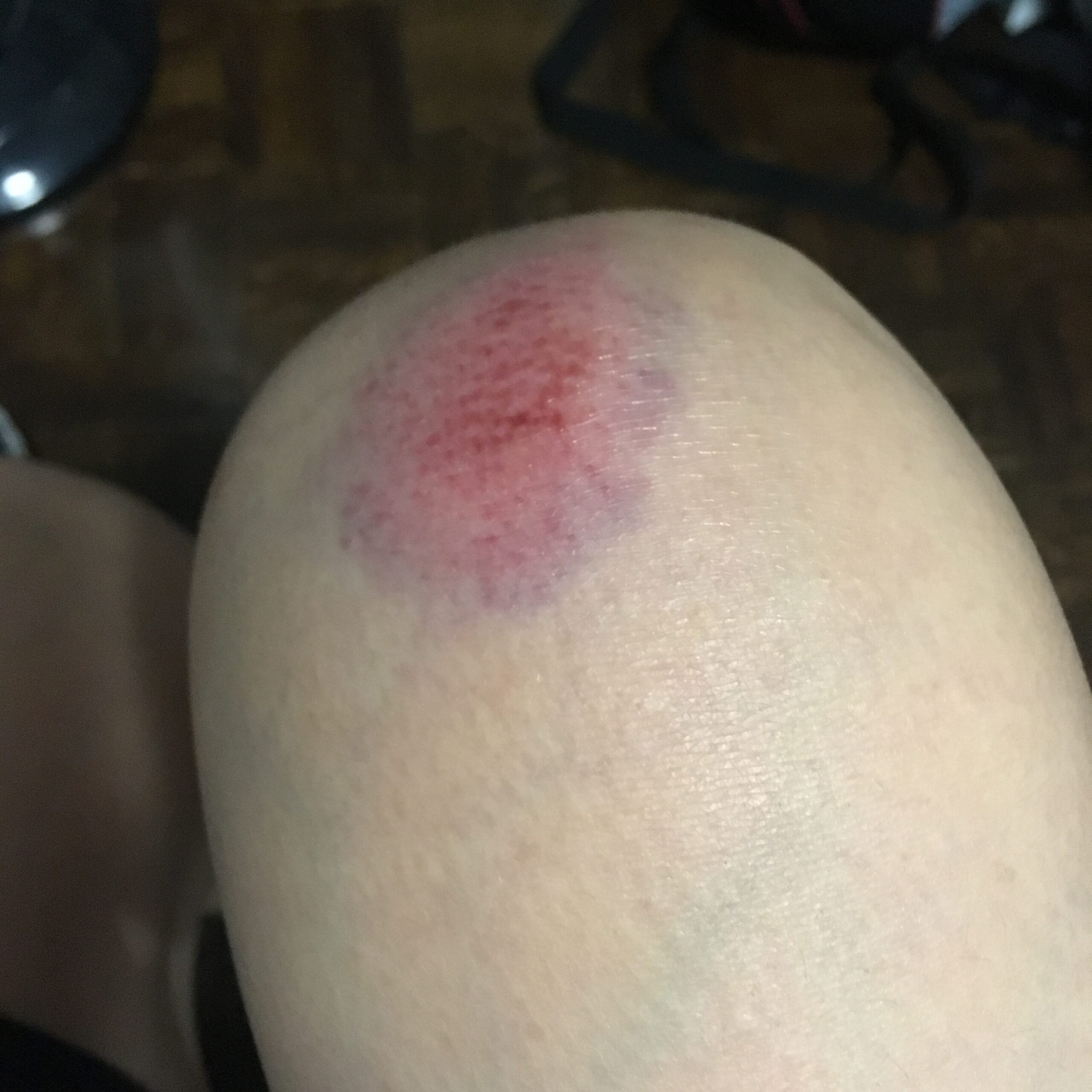 Close up image of bruised knee